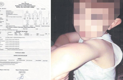 Canavar anne! 4 yaşındaki öz çocuğunun vücudunda sigara söndürmüş