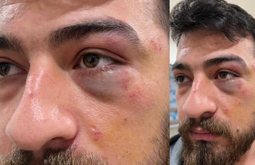 İstanbul'da hemşir ile hasta arasında "eldiveni değiştir" kavgası: 3 gözaltı