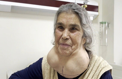 Doktordan korkup senelerce gitmedi, 50 yıl boynundaki büyük parçayla yaşadı