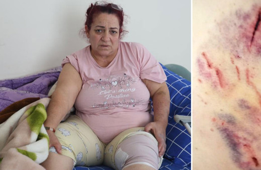 Köpeklerin saldırısına uğrayan kadın: O an öldüğümü sandım!