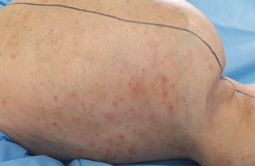 Ameliyatta kesilmekten kurtulan bacağından 6 kilo tümör çıkarıldı