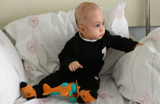 Kafatasında şekil bozukluğu olan 7 aylık bebek ameliyat edildi