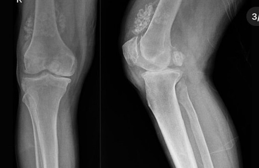Hastanın dizinden 41 eklem faresi çıktı