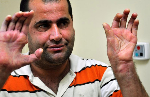 Bu belirtilere dikkat: Cüzzamın erken teşhisinde büyük önem arz ediyor!