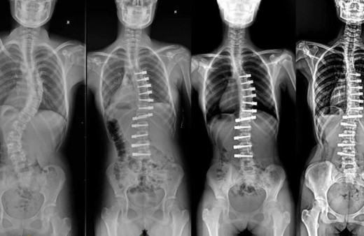 Skolyoz hastası çocuklar için umut olan tedavi!