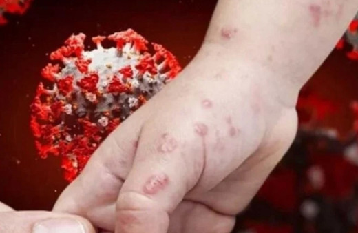 Bakanlık, maymun çiçeği ile ilgili merak edilen soruları cevapladı