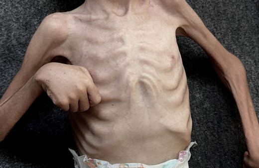 Gazze'den kahreden görüntüler! 6 yaşındaki Kerim yaşam mücadelesi veriyor