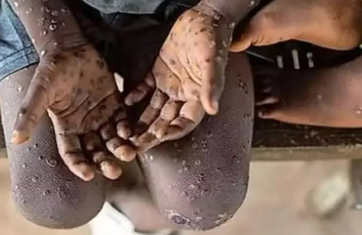 Afrika'da maymun çiçeği kontrolden çıktı