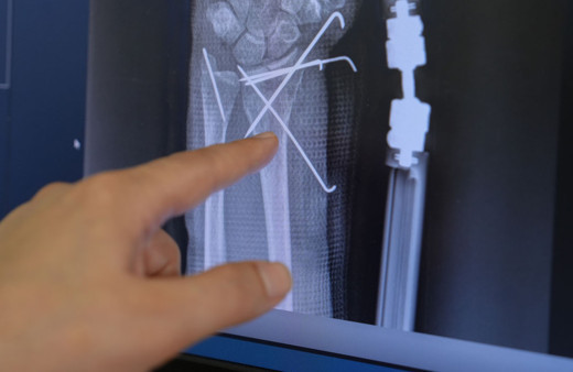 66 yaşında kalçasını ve el bileğini kırdı bir haftada Medipol’de ayağa kalktı