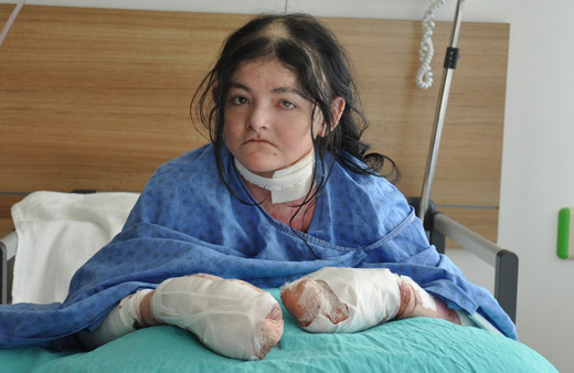 Parmakları bitişikti, ABD'li genç kız şifayı Eskişehir'de buldu! 2 ay içinde...