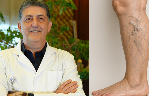 Özellikle kadınlarda görülüyor! Varis artık sorun değil bu yöntemle hızlıca iyileşmek mümkün