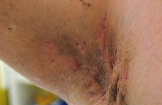 Bu belirtilere dikkat! Koltuk altı ve kasıkta görülüyor!