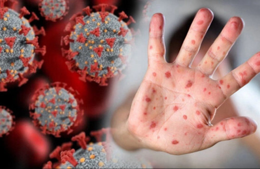 Gana'da M çiçeği vaka sayısı artıyor!