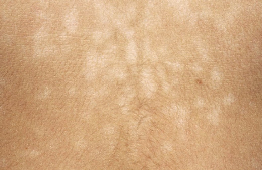 Deniz, havuz, güneş! Ciltte oluşan beyaz lekeler yaz mantarı olabilir...