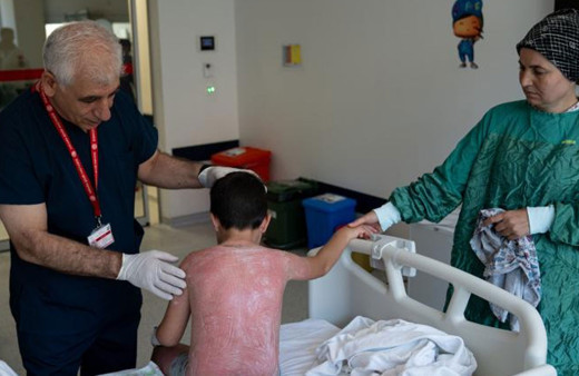 Güneşte 4 saat kalan çocuk, ikinci derece yanık oldu