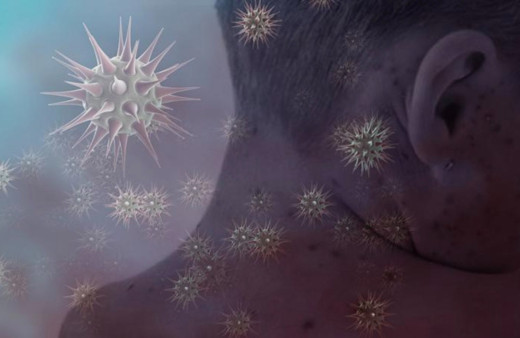 Kızamık vakası can aldı! 17 Kişi hayatını kaybetti...