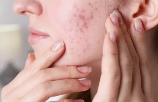 Cilt sorunlarına son! Pürüzsüz bir cilde sahip olmak bu kadar kolay