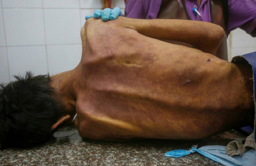 Gazze'de insanlığı utandıran rakam! Açlık nedeniyle 421 kişi can verdi...