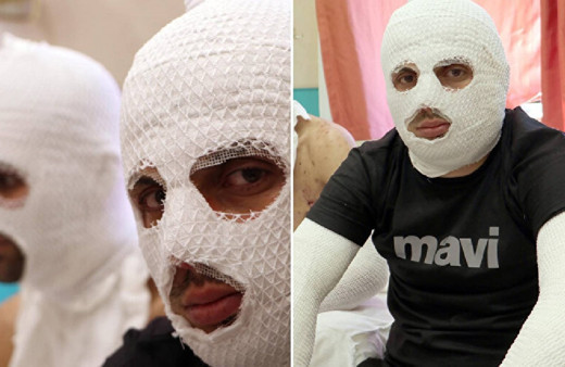 Erzurum'da görülmemiş olay! Araçtaki çakmak tüpü patladı, 2 yaralı