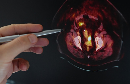 Obezite ve kanser arasındaki tehlikeli bağ!