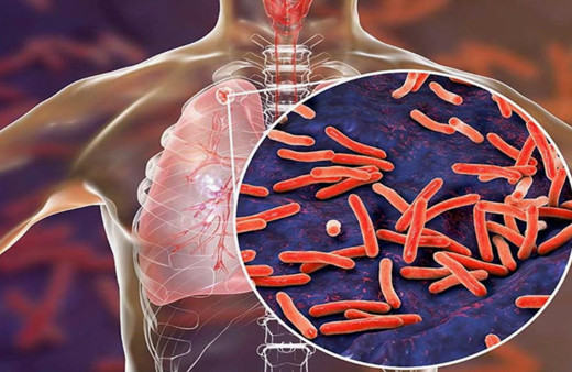 2024'te 1,2 milyondan fazla kişi tüberküloz nedeniyle öldü