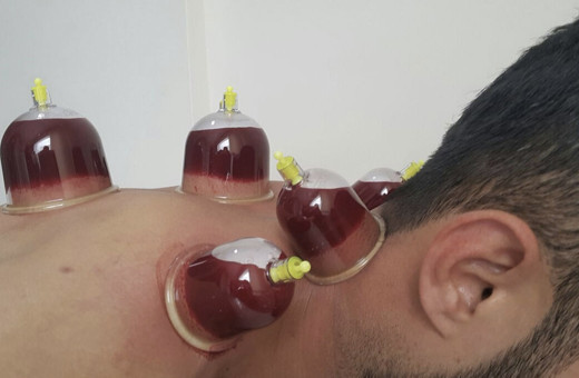 Oruçluyken hacamat yaptırmak orucu bozar mı?