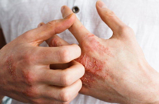 Fazla kolonya kullanımı egzamaya neden oluyor!