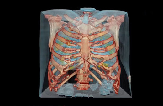Koronavirüs bulunan akciğerin 3D görüntüsü yayımlandı