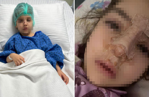 4 yaşındaki çocuğun, kreşte burnu kırıldı! Psikolojik şiddet iddiası da var!