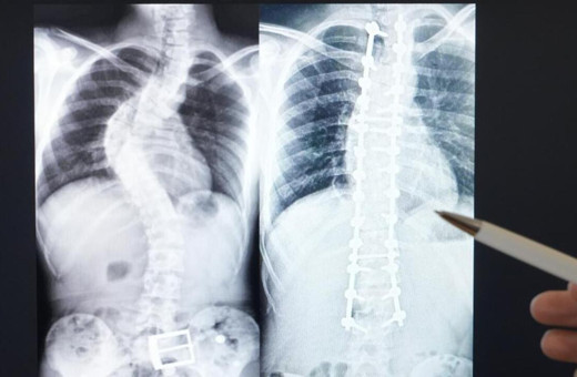 Skolyozun belirlenmesinde ailelere büyük görev düşüyor