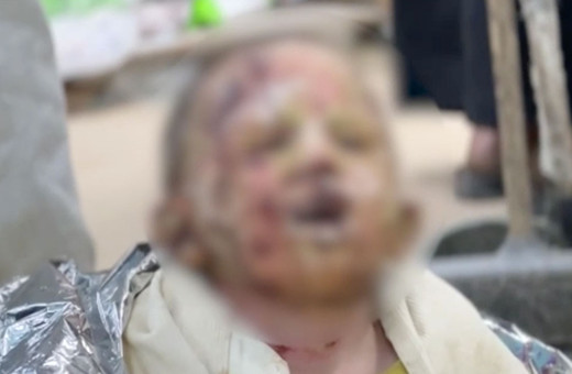 İsrail ordusu, bedeninde derin yanıklar açtığı 4 yaşındaki Seca’yı hastanede de rahat bırakmadı