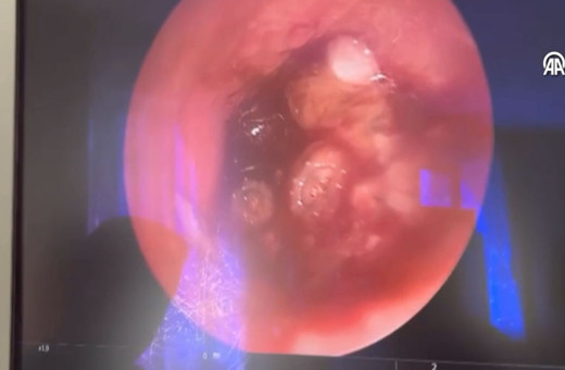 Ağrı şikayetiyle hastaneye götürdüler! Kulağından çıkan şoke etti