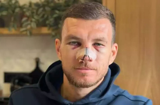 Burnu kırılan Edin Dzeko ameliyat edilecek mi?