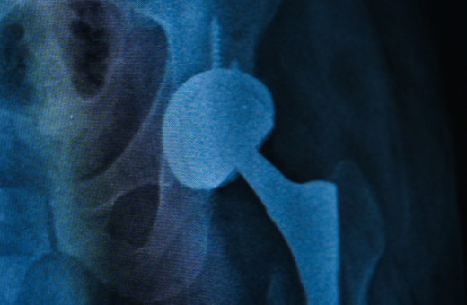 Dört yıllık ağrılı yaşam tek ameliyatla bitti! Protez değişimi nasıl uygulanıyor?