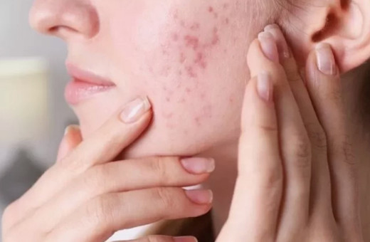 Cilt sorunlarına son! Pürüzsüz bir cilde sahip olmak bu kadar kolay