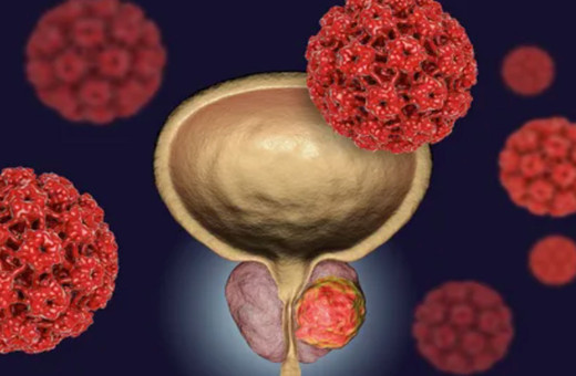 Erkeklerde en çok bu kanser türü görülüyor, aman dikkat!