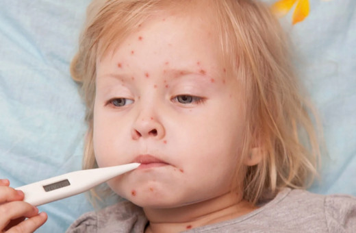 Su çiçeği vakaları artıyor! Uzmanlardan su çiçeği uyarıyor! Salgın riski var mı?