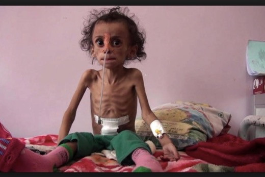 Yemen açlıktan ölüyor çocuklar bir deri bir kemik son duruma bakın - Resim: 3
