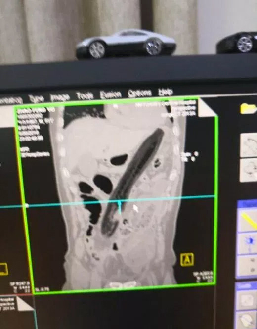 Karın ağrısıyla hastaneye koştu içinden devasa bir patlıcan çıktı - Resim: 4