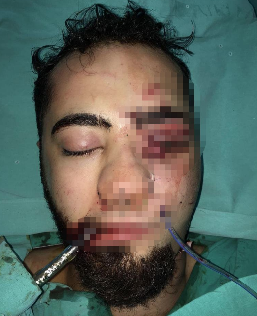 Gencin yüzüne saplanan çubuk için hastanedeki operasyona itfaiye ekibi de dahil oldu - Resim: 2