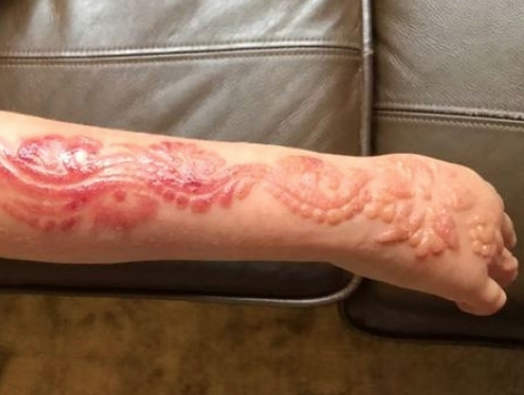 Kesinlikle yaptırmayın cilde inanılmaz zararları bulunuyor! - Resim: 4