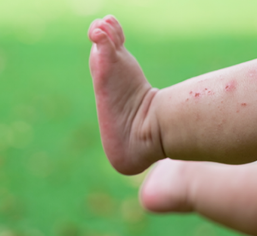 Ayağımda kırmızı lekeler var kırmızı lekeler neden olur - Resim: 3