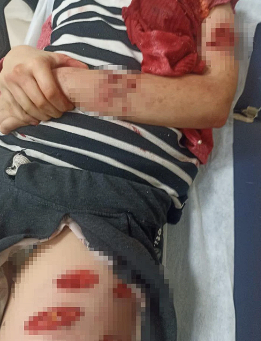 Şanlıurfa'da sokak köpeği saldırısı! Kız çocuğunu resmen parçalamışlar - Resim: 2