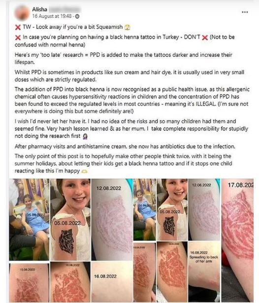 Türkiye tatilinde yaptırdığı kına dövmesi minik İngiliz çocuğun hayatını kararttı - Resim: 1