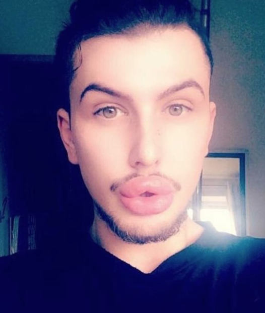 Görenler şaşıp kaldı! Dudakları patlama noktasına geldi - Resim: 4