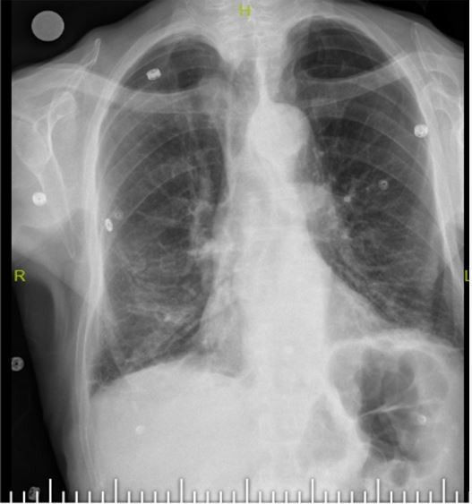 Elazığ'da yaşlı adamın boğazından 10 Santimetrelik çivi çıkarıldı - Resim: 3