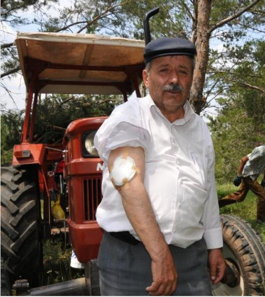 15 yıl kolundaki bezle yaşadı - Resim: 2