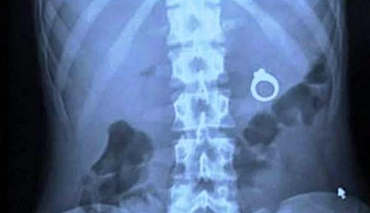 XRay'lerde insanların içinde görüntülenen en acayip şeyler - Resim: 2