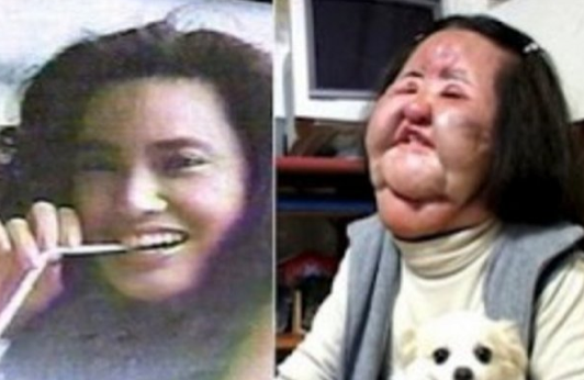 Yüzüne yemeklik yağ enjekte edince...  - Resim: 3