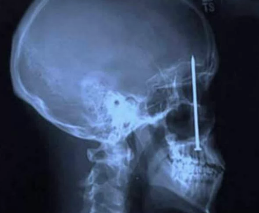 XRay'lerde insanların içinde görüntülenen en acayip şeyler - Resim: 1